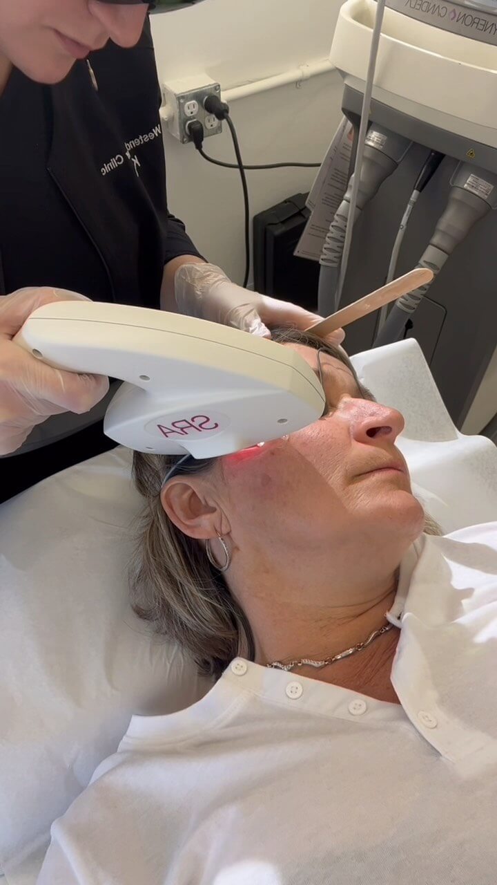 IPL SPOT TREATMENT PROCESS💥 ⁣
⁣
Any unwanted hyperpigmentation can be targeted with IPL (intense pulse light) ⁣
⁣
🏷️ Price starting at 95$ per session. ⁣
1-3 sessions required for best results. ⁣
⁣
📲Dm us today to book to have your unwanted pigmentation removed. ⁣
⁣
#laser #ipl #photofacial #iplspottreatment #laserclinic #ottawa
