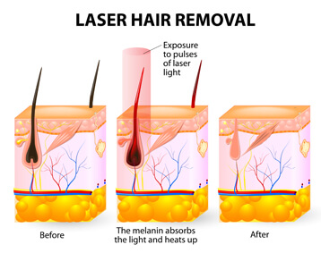 Elos laser hair clearance removal