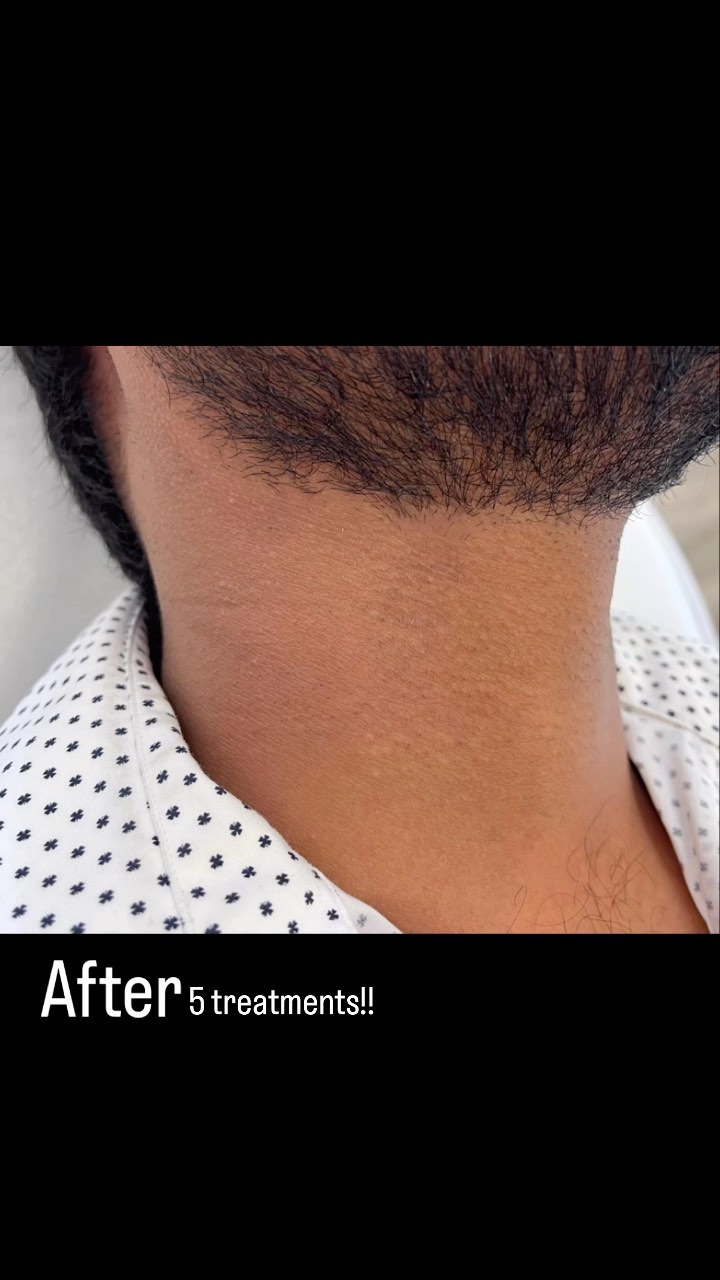 Satisfying, clean, beard/neck line 🤩 ⁣
⁣
•No more shaving, trimming⁣
•No more ingrowns
•No more stubble ⁣
=Smooth skin! ⁣
⁣
#laserhairremoval #ottawa #beforeandafterlaserhairremoval #beard #necklaser